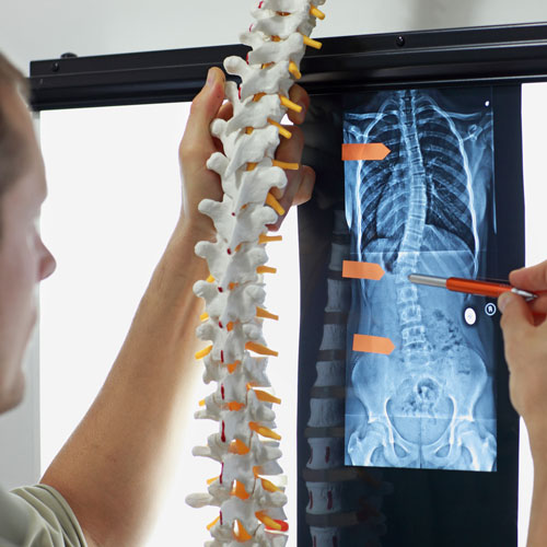 The Effects of Spinal Misalignment on the Body